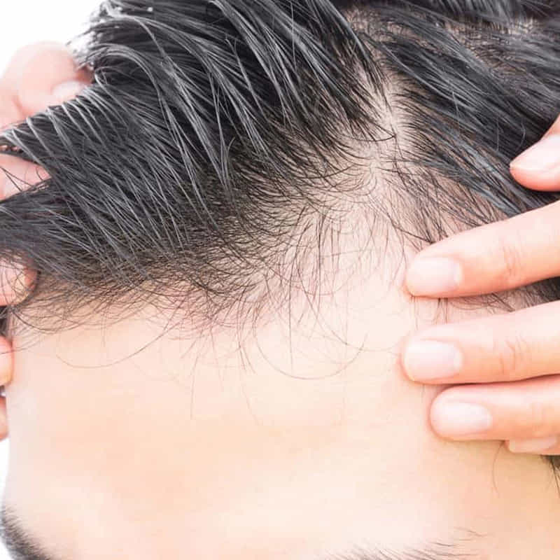 Why Millennial Are Facing Hair Casualties?